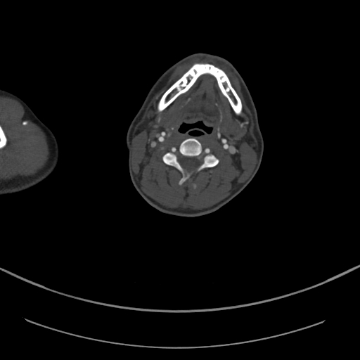 Brachiocephalic trunk pseudoaneurysm (Radiopaedia 70978-81191 Axial bone window 13).jpg