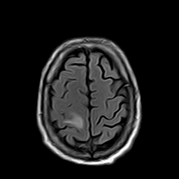File:Brain abscess complicated by intraventricular rupture and ventriculitis (Radiopaedia 82434-96571 Axial FLAIR 20).jpg
