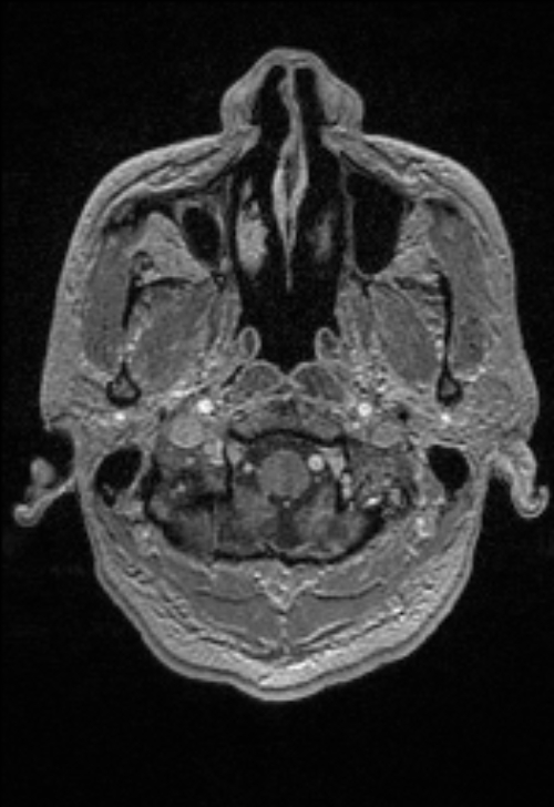 Brain abscess with ventriculitis (Radiopaedia 85703-101495 Axial T1 C+ 24).jpg