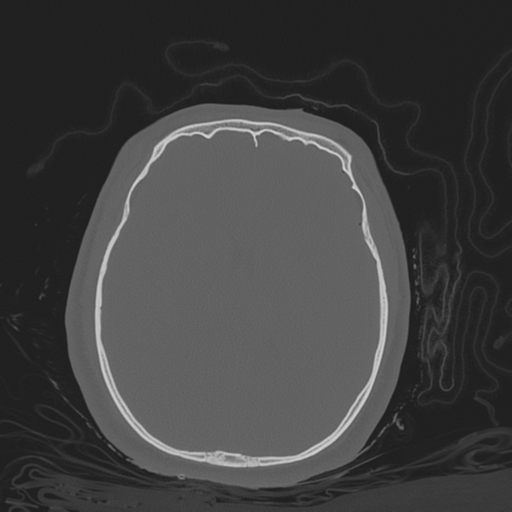 File:Brain contusions, internal carotid artery dissection and base of skull fracture (Radiopaedia 34089-35339 Axial bone window 81).png