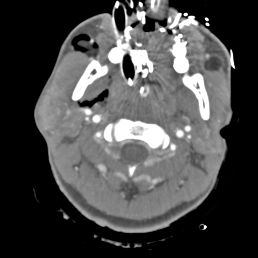 Brain contusions, internal carotid artery dissection and base of skull fracture (Radiopaedia 34089-35339 D 59).png