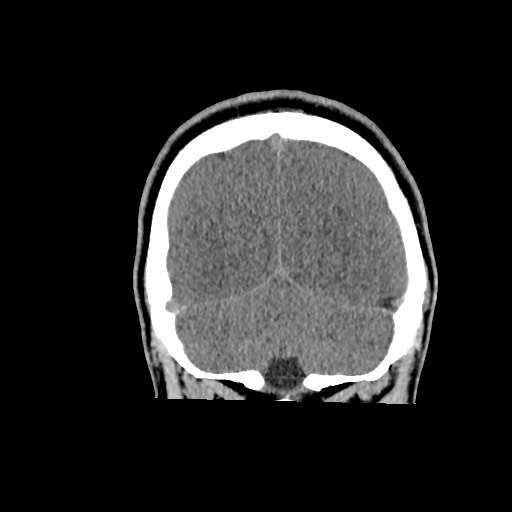 Brain death (Radiopaedia 78597-91360 Coronal non-contrast 61).jpg