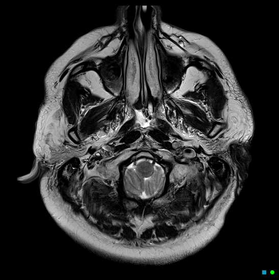 File:Brain death on MRI and CT angiography (Radiopaedia 42560-45689 Axial T2 4).jpg