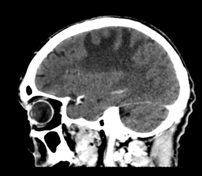 Brain metastases from lung cancer (Radiopaedia 27849-28092 Sagittal C+ delayed 19).jpg
