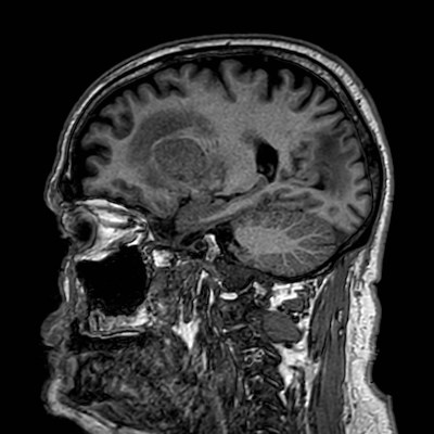 Brain metastases from lung cancer (Radiopaedia 83839-99028 Sagittal T1 44).jpg