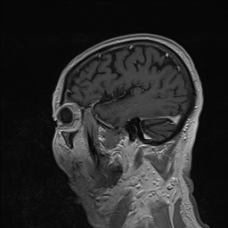 Brain metastasis (Radiopaedia 42617-45761 Sagittal T1 C+ 77).jpg