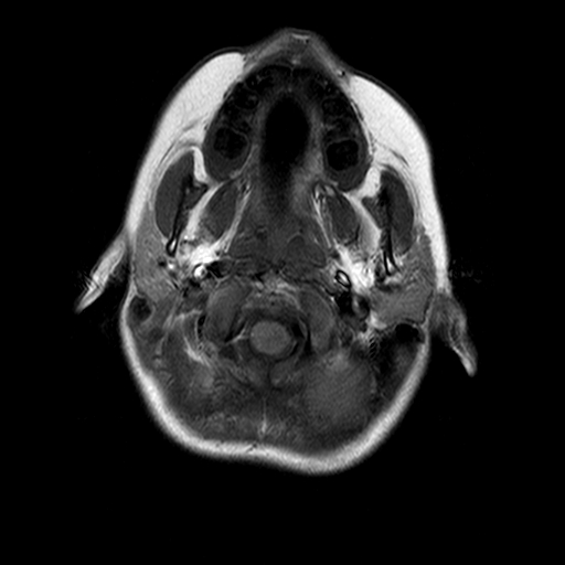 File:Brainstem ganglioglioma (Radiopaedia 10763-11224 Axial T1 18).jpg