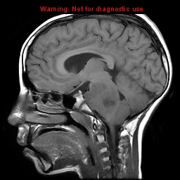 File:Brainstem glioma (Radiopaedia 9444-10124 Sagittal T1 6).jpg
