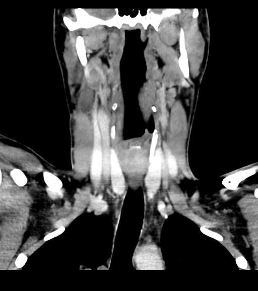 Branchial cleft cyst (Radiopaedia 31167-31875 Coronal C+ delayed 33).jpg