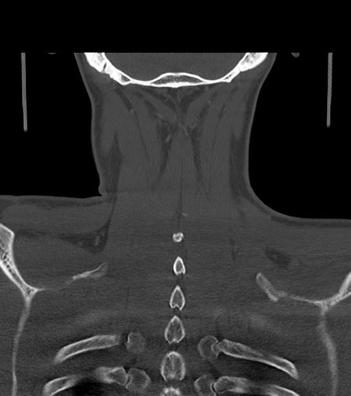 File:Branchial cleft cyst (Radiopaedia 31167-31875 Coronal bone window 53).jpg