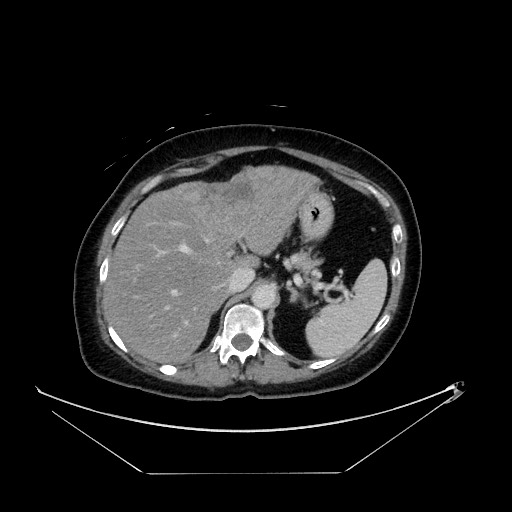 File:Breast cancer pseudocirrhosis with lobar invovlement (Radiopaedia 81080-94670 A 46).jpg