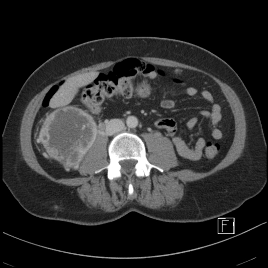 File:Breast metastases from renal cell cancer (Radiopaedia 79220-92225 C 58).jpg