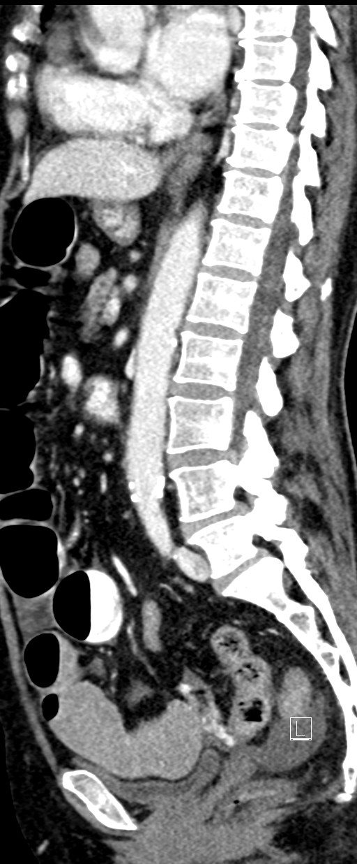 Broad ligament hernia (Radiopaedia 84802-100276 C 36).jpg