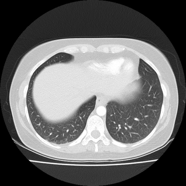 Bronchial atresia (Radiopaedia 22965-22992 Axial lung window 13).jpg