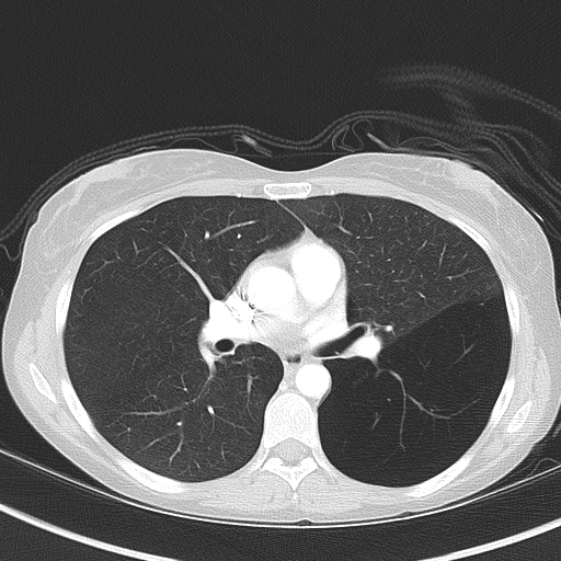 File:Bronchial atresia (Radiopaedia 73677-84470 Axial lung window 30).jpg
