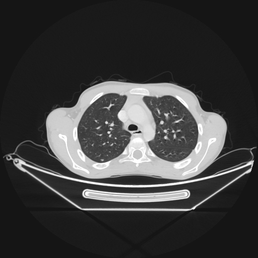 Bronchial carcinoid tumor (Radiopaedia 57187-64090 Axial lung window 21).jpg