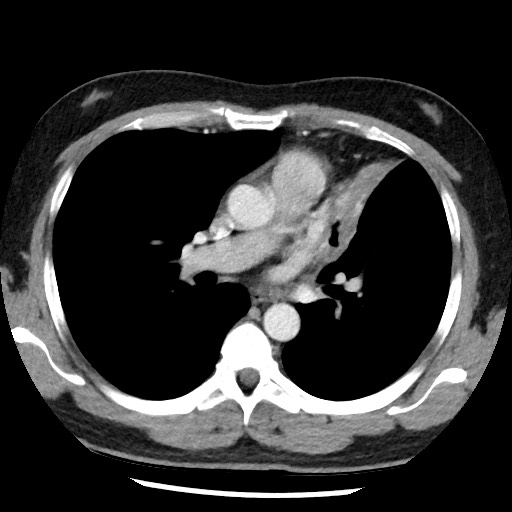 Bronchial carcinoid tumor (Radiopaedia 67377-76764 A 31).jpg