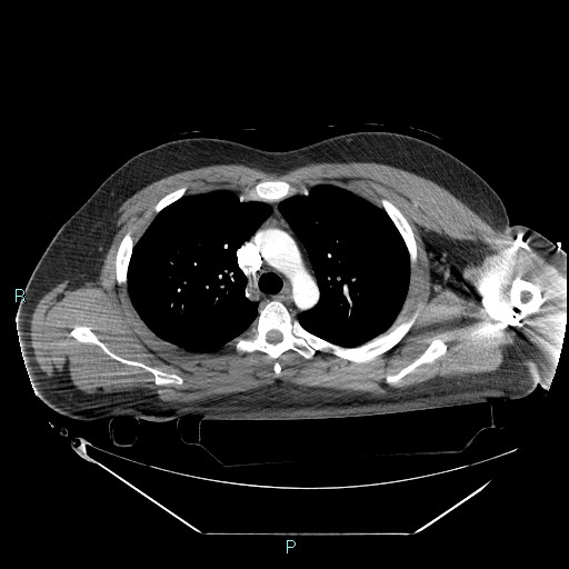 Bronchial carcinoid tumor (Radiopaedia 78272-90870 B 42).jpg