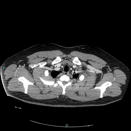 Bronchial carcinoid tumor (Radiopaedia 78272-90875 A 17).jpg