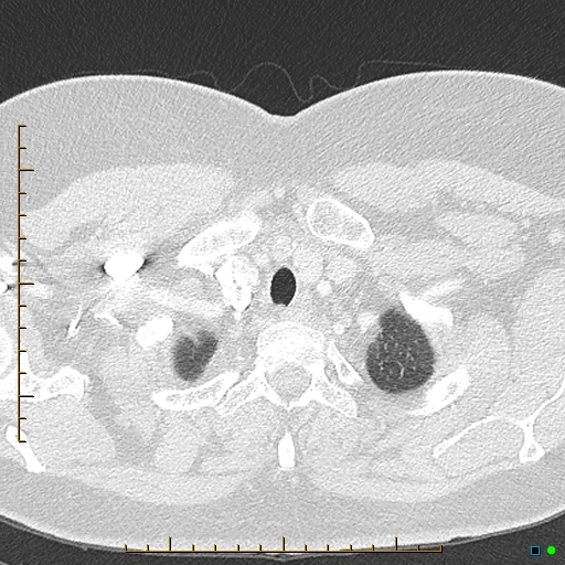 Bronchial diverticula (Radiopaedia 79512-92676 Axial lung window 4).jpg