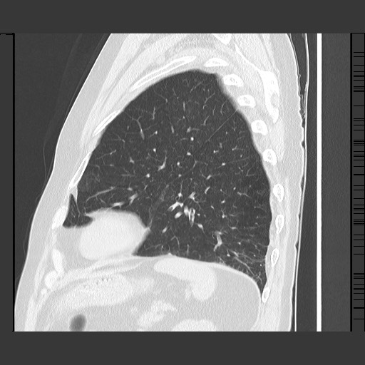 Bronchial stenosis - lung transplant (Radiopaedia 73133-83848 Sagittal lung window 53).jpg