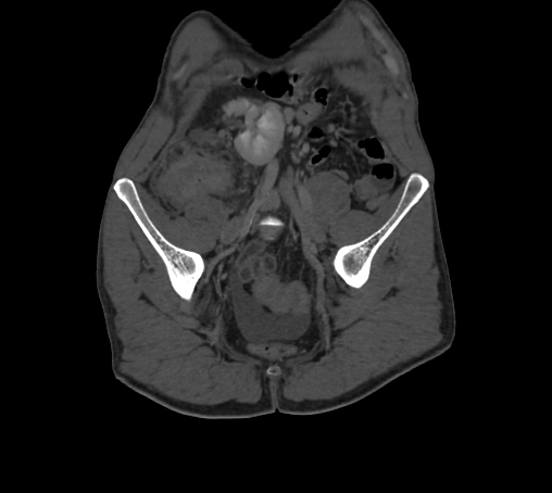 Bronchiectasis in Crohn disease (Radiopaedia 60311-67977 Coronal bone window 1).jpg