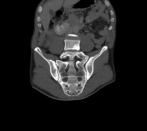 File:Bronchiectasis in Crohn disease (Radiopaedia 60311-67977 Coronal bone window 35).jpg