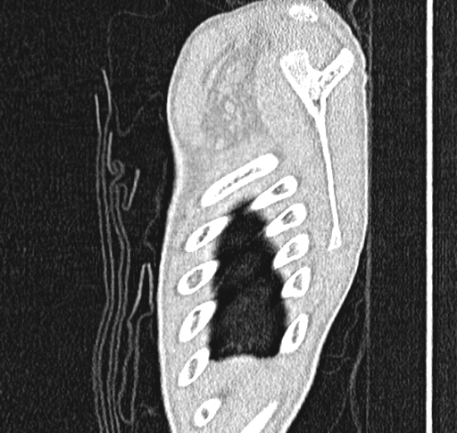 Bronchiolitis obliterans (Radiopaedia 71538-81897 Sagittal lung window 1).jpg
