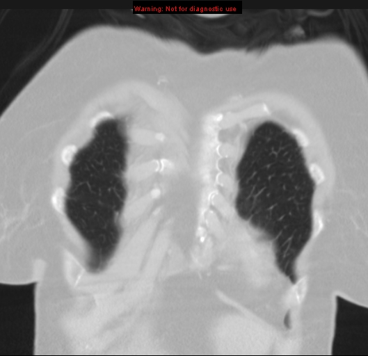 Bronchoalveolar carcinoma (BAC) (Radiopaedia 13436-13392 Coronal lung window 8).jpg