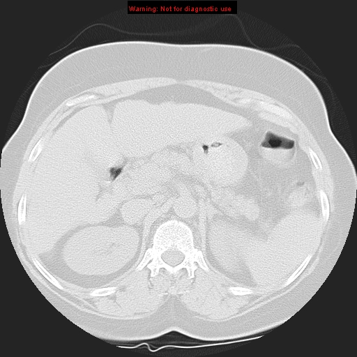Bronchoalveolar carcinoma (Radiopaedia 13224-13233 Axial lung window 51).jpg