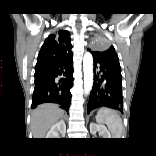File:Bronchogenic carcinoma with left atrial large deposit - T4N3M1a (Radiopaedia 42316-45428 B 12).jpg