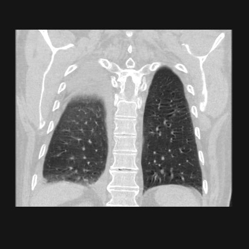 File:Bronchogenic carcinoma with metastatic lymphadenopathy (Radiopaedia 37671-39569 Coronal lung window 37).jpg