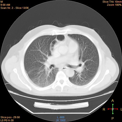 File:Bronchogenic carcinoma with superior vena caval invasion (Radiopaedia 22378-22406 lung window 10).jpg