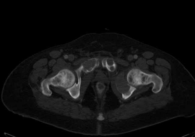 Brown tumors compressing the spinal cord (Radiopaedia 68442-77988 G 125).jpg