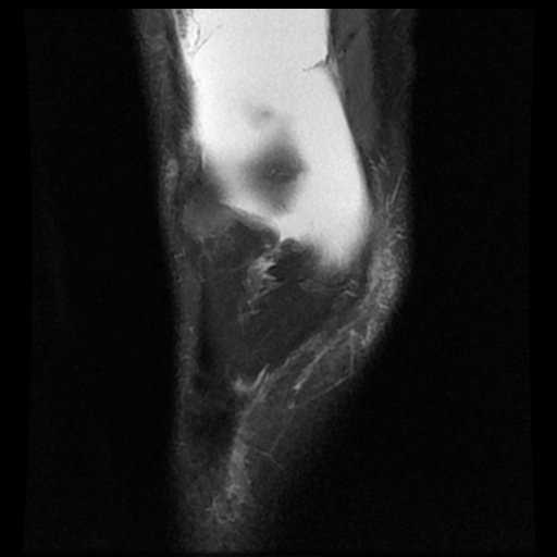 File:Bucket handle meniscus tear (Radiopaedia 56916-63751 Coronal PD fat sat 4).jpg