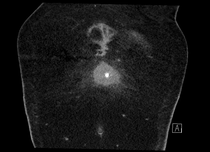Buried bumper syndrome - gastrostomy tube (Radiopaedia 63843-72577 Coronal Inject 14).jpg