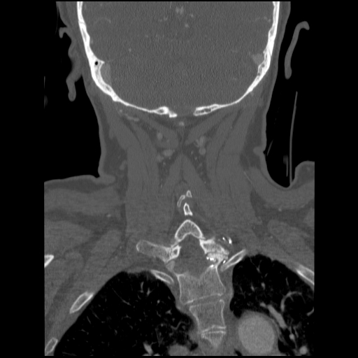 File:C1 anterior arch (plough) fracture - type 1 (Radiopaedia 76181-87720 Coronal bone window 27).jpg