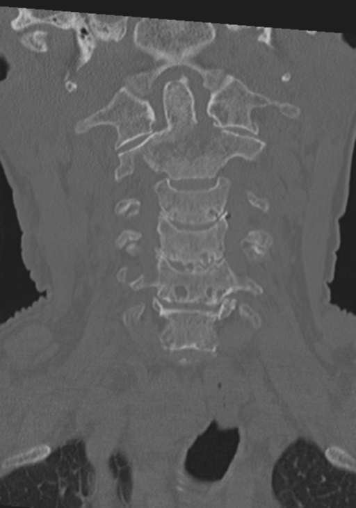 C2 fracture with vertebral artery dissection (Radiopaedia 37378-39199 Coronal bone window 13).png