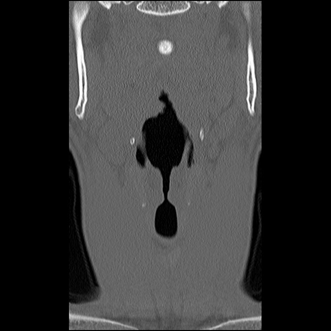 C5 facet fracture (Radiopaedia 58374-65499 Coronal bone window 13).jpg