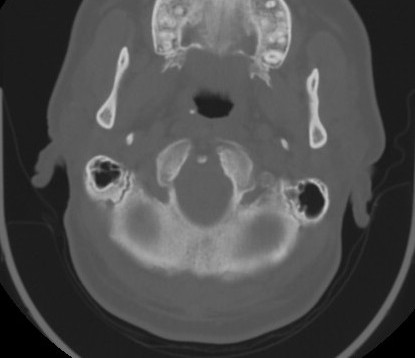 File:C7 laminar fracture and Klippel-Feil syndrome (Radiopaedia 86710-102850 Axial bone window 20).jpg