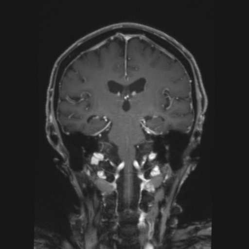 File:CNS lymphoma with steroid response (Radiopaedia 37980-39921 Coronal T1 C+ 26).png