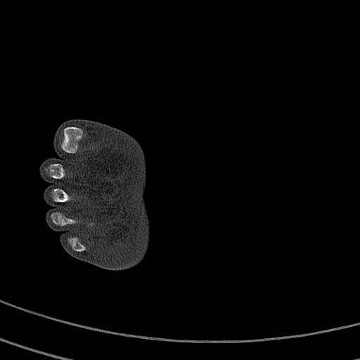 File:Calcaneal fracture - Sanders type 4 (Radiopaedia 90179-107370 Axial bone window 64).jpg
