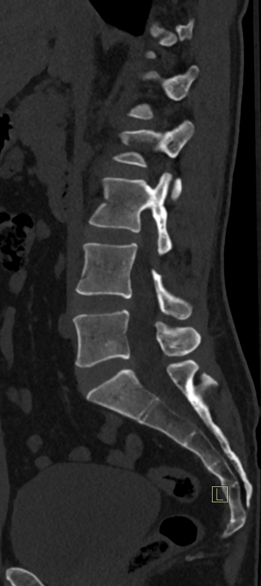 Calcaneal fractures with associated L2 burst fracture (Radiopaedia 71671-82493 Sagittal bone window 46).jpg
