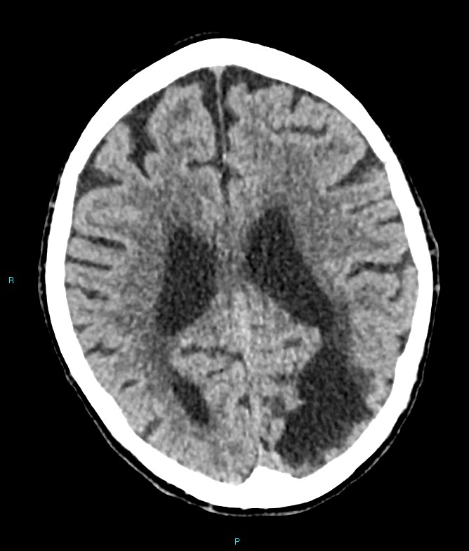 Calcified cerebral emboli from left ventricular thrombus (Radiopaedia 84420-99758 Axial non-contrast 37).jpg