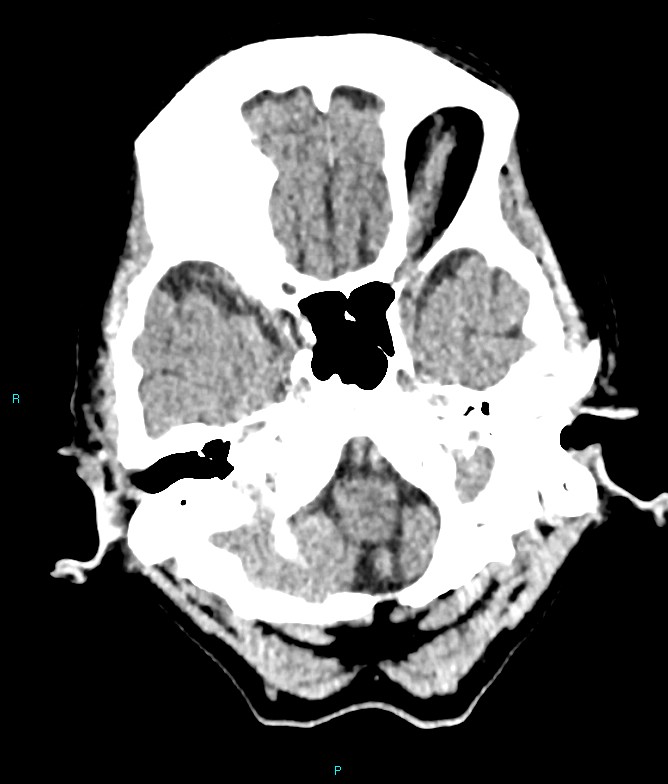 Calcified cerebral emboli from left ventricular thrombus (Radiopaedia 84420-99758 Axial non-contrast 76).jpg