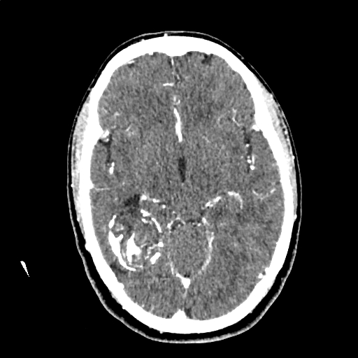 File:Calcified cerebral hydatid cyst (Radiopaedia 65603-74717 Axial with contrast 31).jpg