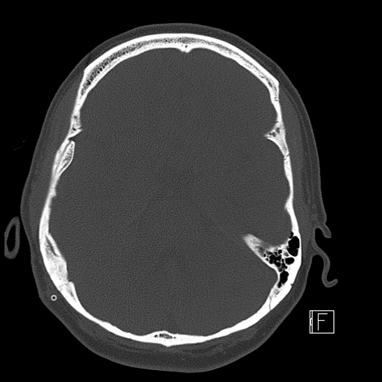 Calcified chronic subdural hematoma (Radiopaedia 77374-89492 Axial bone window 43).jpg