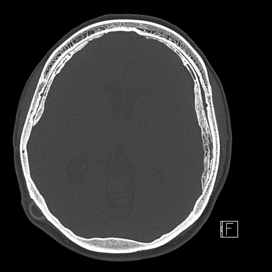 Calcified chronic subdural hematoma (Radiopaedia 77374-89492 Axial bone window 69).jpg