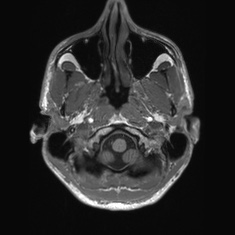 Callosal dysgenesis with interhemispheric cyst (Radiopaedia 53355-59335 Axial T1 14).jpg