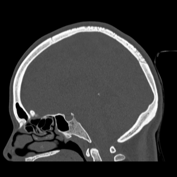 Calvarial osteoma (Radiopaedia 36520-38079 Sagittal bone window 54).jpg